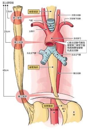 女子鱼刺卡喉大口吞饭刺入心脏主动脉险送命