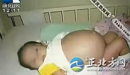 七个月男婴剖腹产女惊骇双亲 寄生胎死于腹中