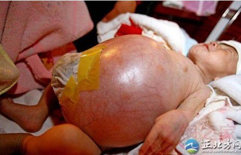七个月男婴剖腹产女惊骇双亲 寄生胎死于腹中